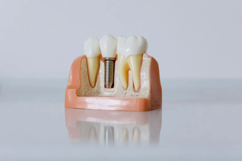 The Real Cost of Dental Implants in 2026: A Complete Guide