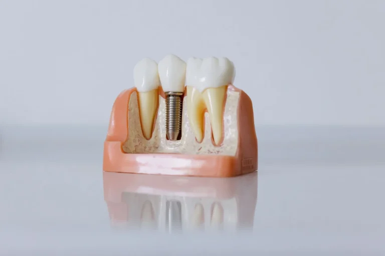 The Real Cost of Dental Implants in 2026