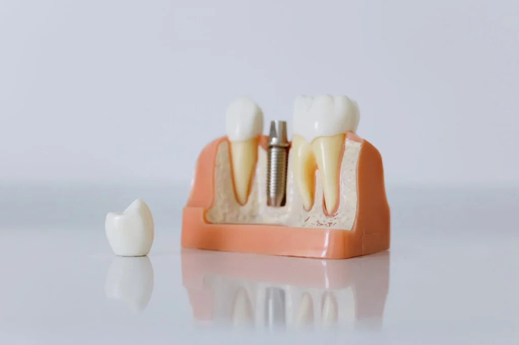 The Real Cost of Dental Implants in 2026
