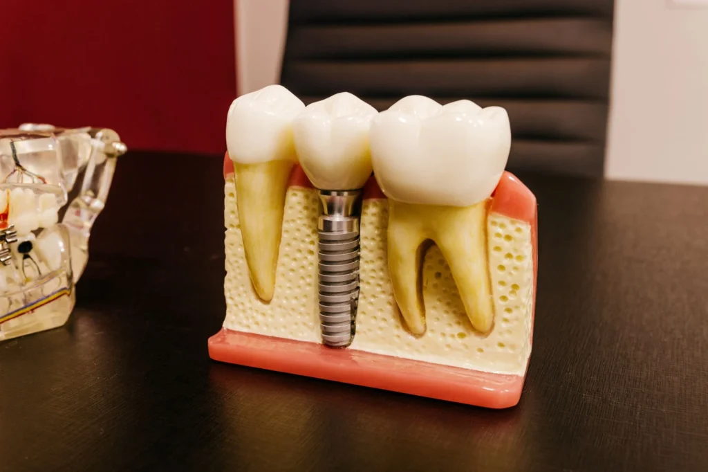 The Real Cost of Dental Implants in 2026: Your Updated Guide